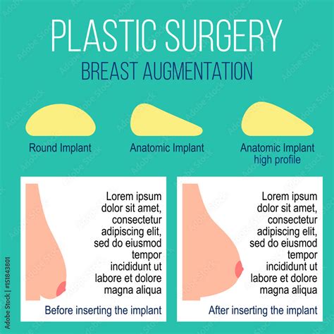 隆胸|Breast Augmentation: What it is, Types, Surgery